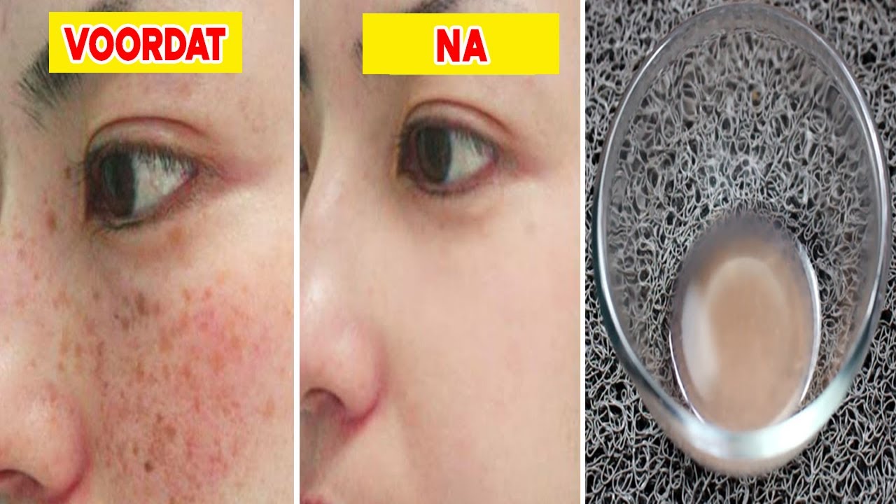 Beroemde dermatoloog onthuld: Verwijder bruine vlekken op gezicht en - Rode Vlekken Op Benen Door Zon