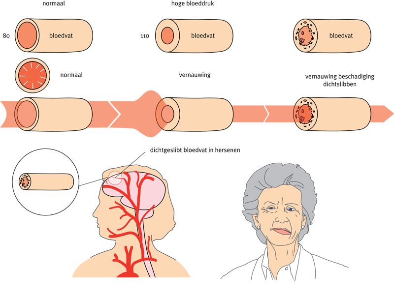 Beroerte - Verschil Herseninfarct En Hersenbloeding En Tia