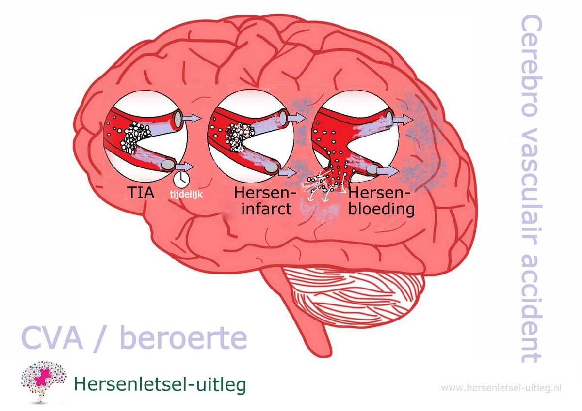 Wat Is Cva Voor Ziekte