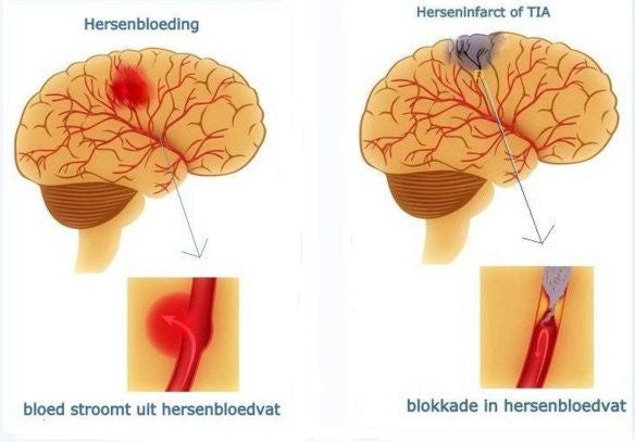 Beroerte, CVA | Hersenletsel-uitleg.nl - Wat Is Cva Voor Ziekte