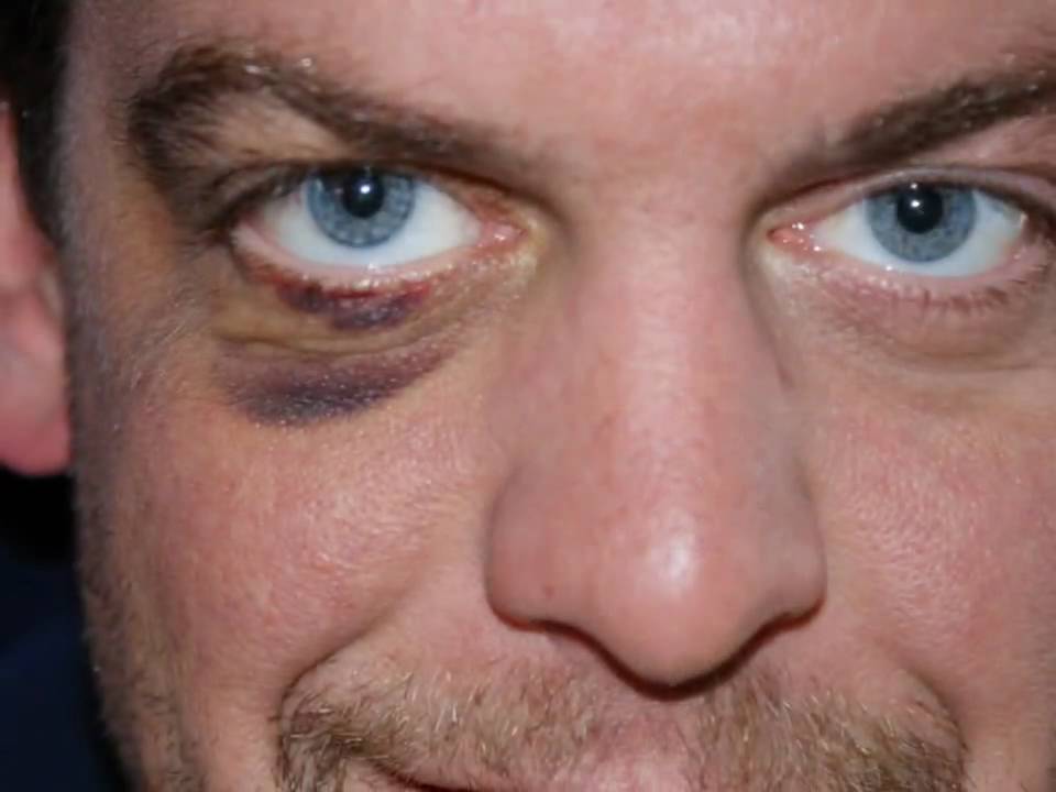 Hoe Gaat Een Blauwe Plek Sneller Weg