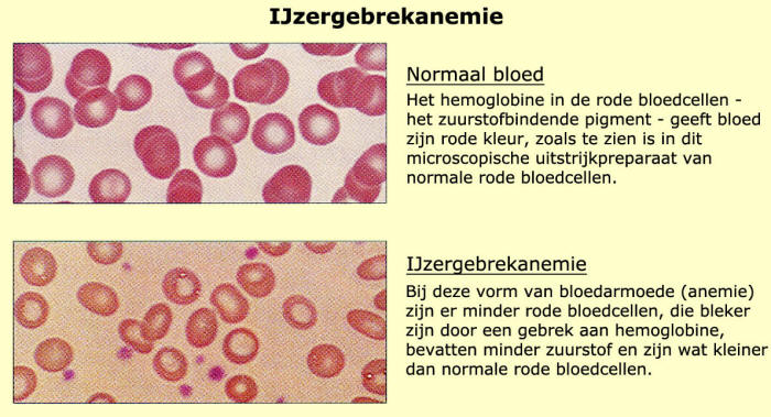 Bloedarmoede - Te Veel Koolzuur In Bloed Symptomen