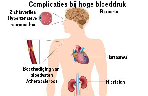 Bloedvaten reinigen op natuurlijke wijze dankzij Santurel - Wat Voel Je Bij Hoge Bloeddruk