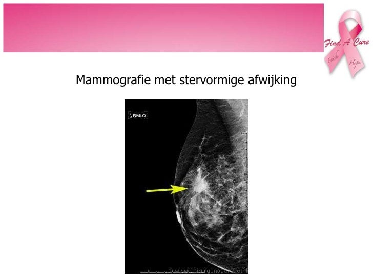 Borstkanker - Hoe Ziet Inflammatoire Borstkanker Eruit