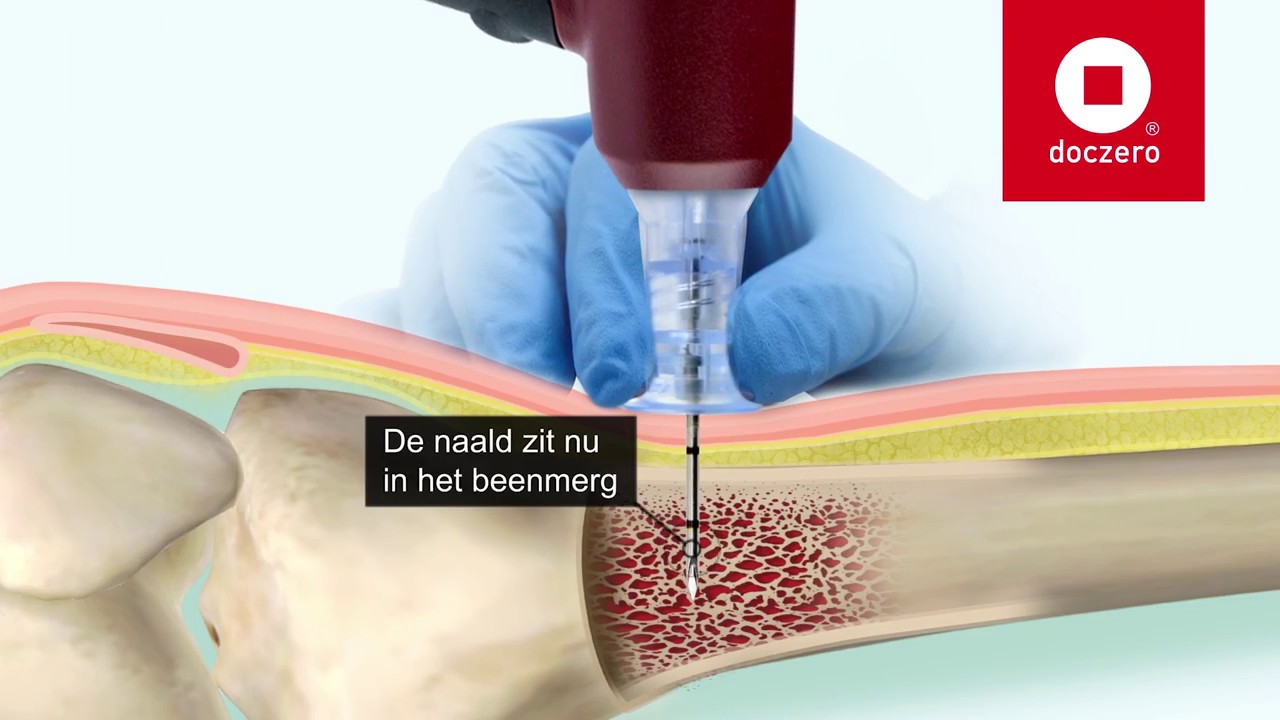 Botnaald inbrengen | Doczero E-learning - YouTube - Wat Is Fixeren In De Zorg