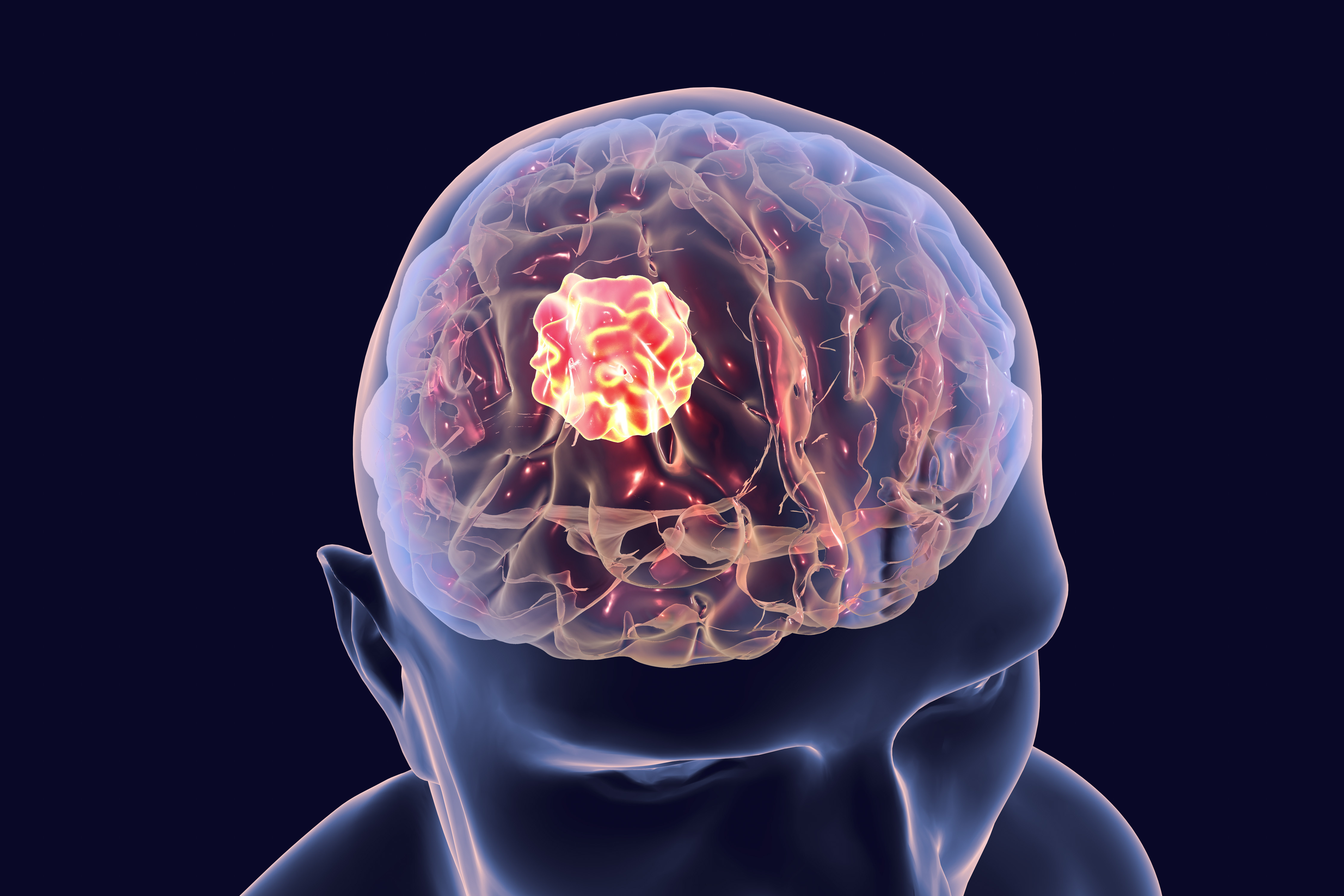 Tumor Met Haren En Tanden