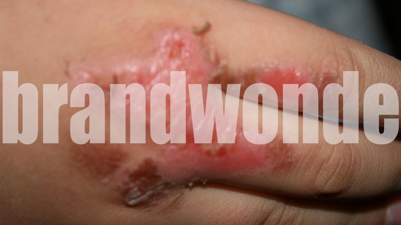 1e 2e 3e Graads Brandwonden