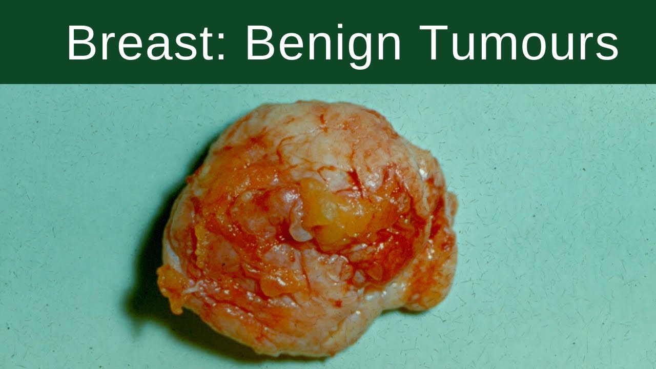 Breast: Benign Tumours - Pathology mini tutorial - YouTube - Benigne Tumor In Functioneel Gebied 1-3