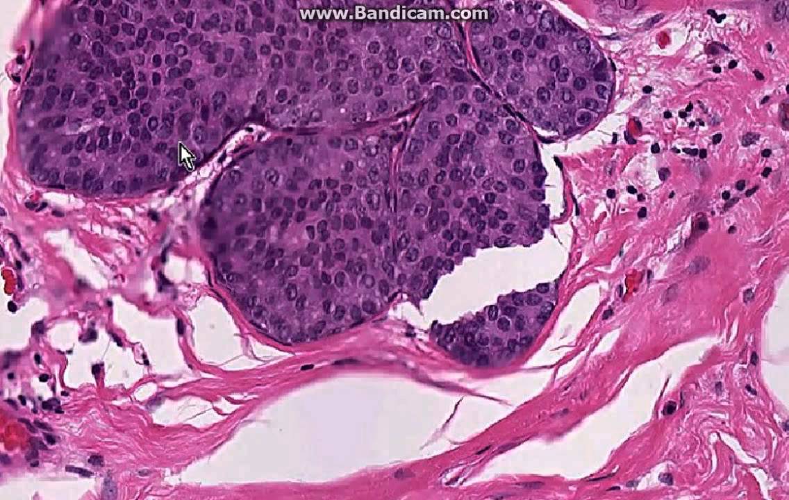 Breast cancer- Lobular carcinoma in situ - YouTube - Invasief Carcinoom Nst Graad 2