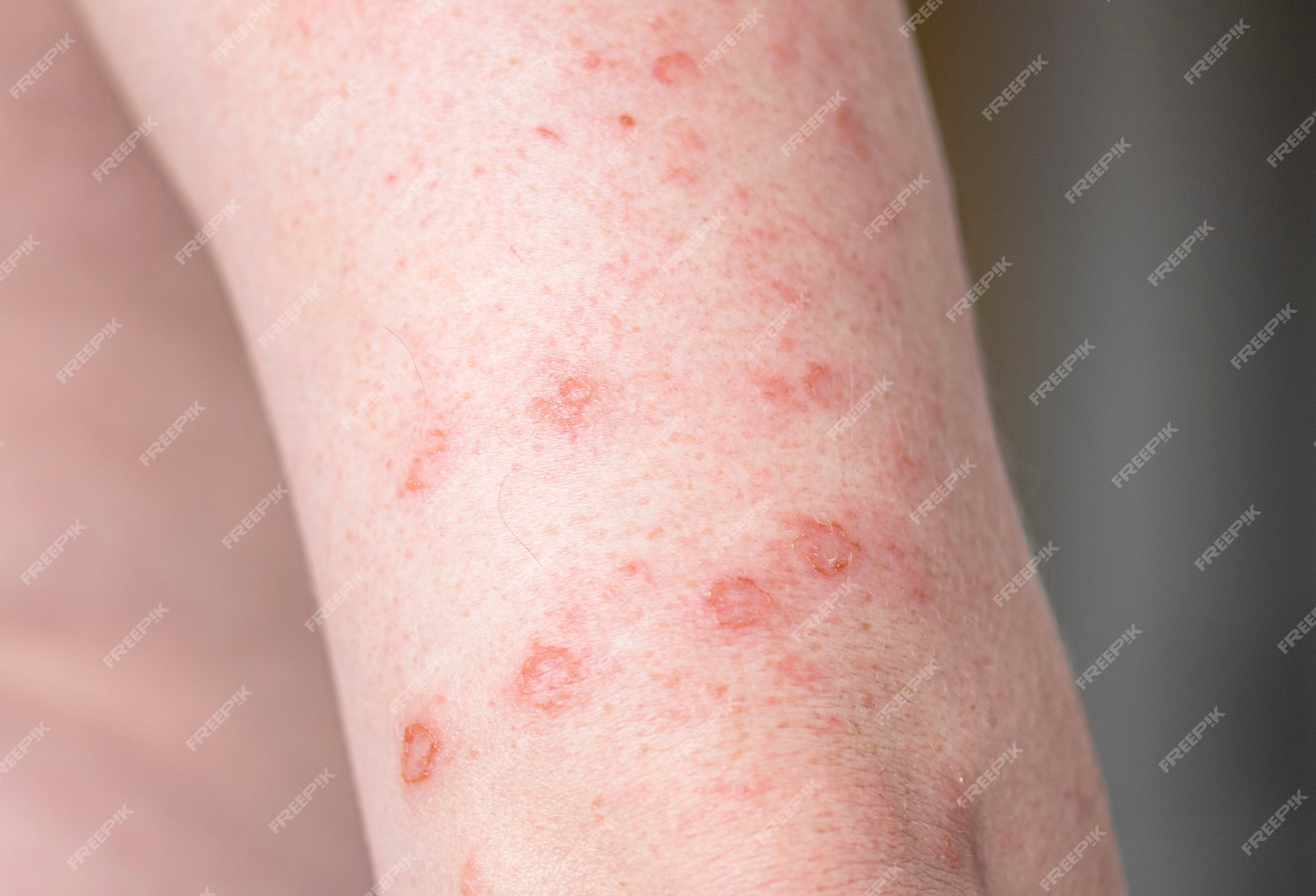 Bumps On Skin That Dont Itch - Rode Vlekken Op Benen Door Zon
