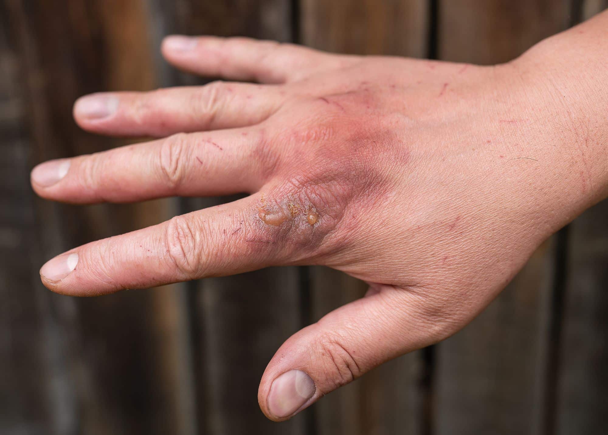 Burns And Heat Injury Treatment First Aid For 2024 - Hoe Ziet Een Derdegraads Brandwond Eruit