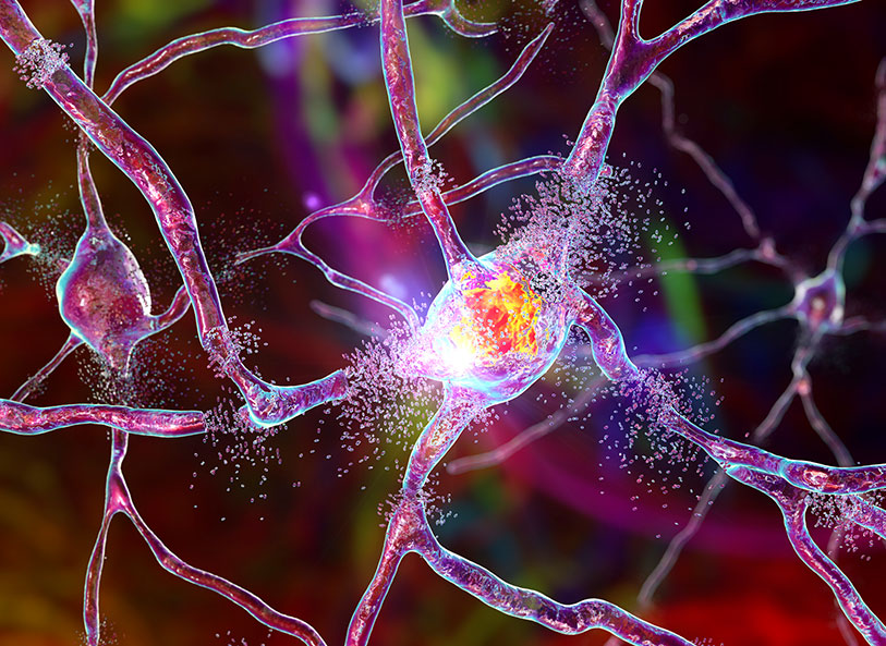Can We Prevent Neuron Death? The Root of Alzheimer's Disease - Wat Is De Oorzaak Van Alzheimer