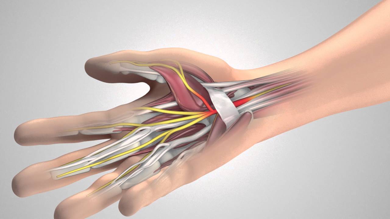 Carpaal Tunnelsyndroom (2) De Operatie - YouTube - Tinteling In Pink En Ringvinger