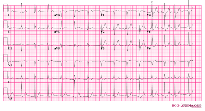 Case 5 - ECGpedia - Hoe Ziet Een Normale Ecg Eruit