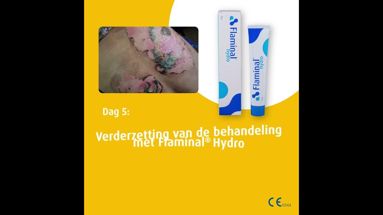 Case studie - Flaminal® voor de behandeling van 2de graads brandwonden - Hoeveel Verbrand Je Met Zwemmen
