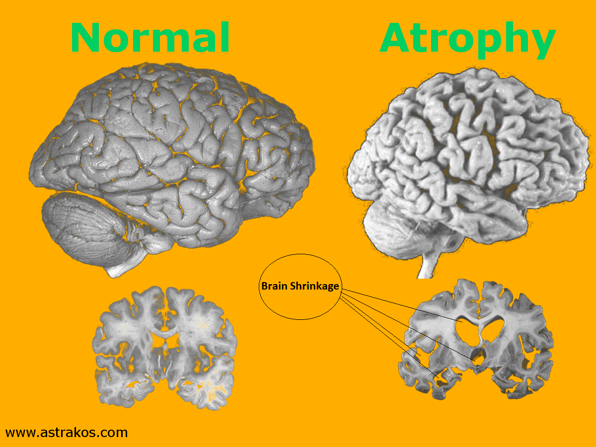 Globale Corticale Atrofie Graad 2