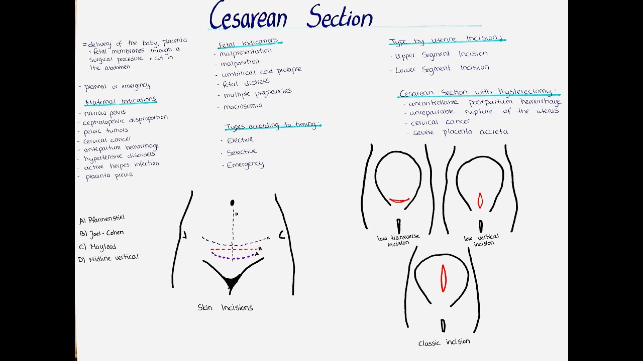 Cesarean Section - Types, Indications, Incisions etc - YouTube - Wat Is Een C Section