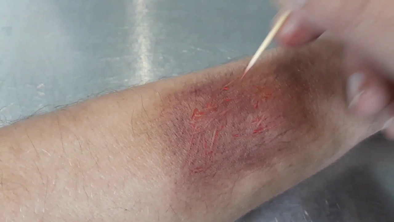 chemische brandwonden - YouTube - 1e 2e 3e Graads Brandwonden