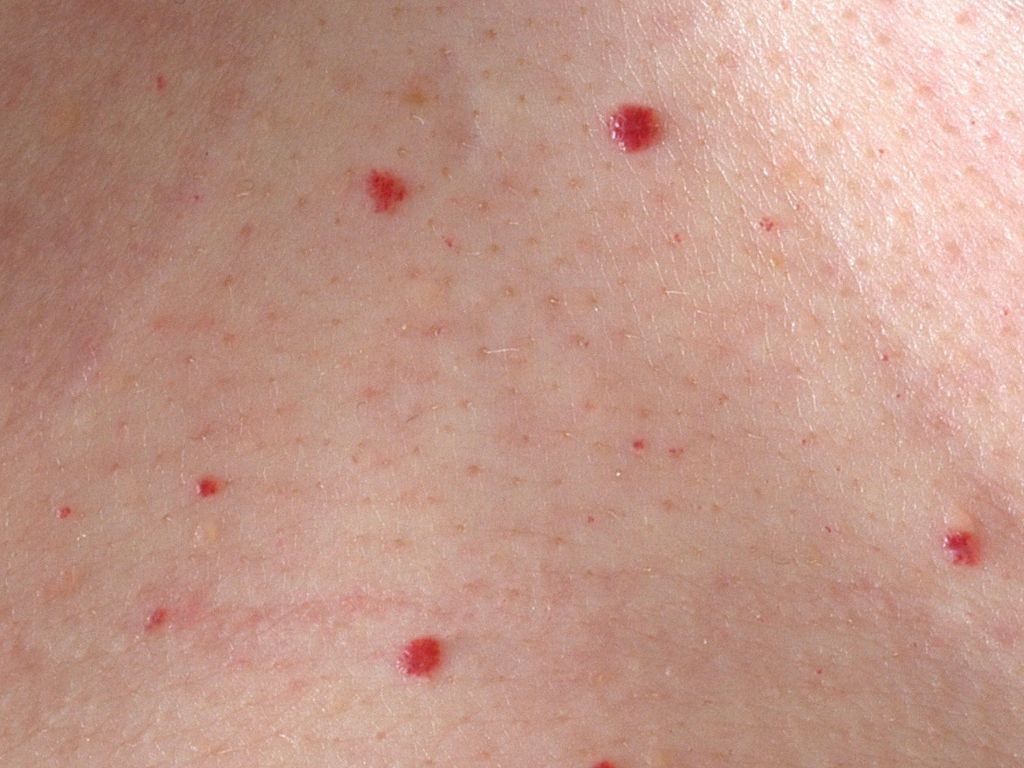 Rode Bult Met Zwart Puntje