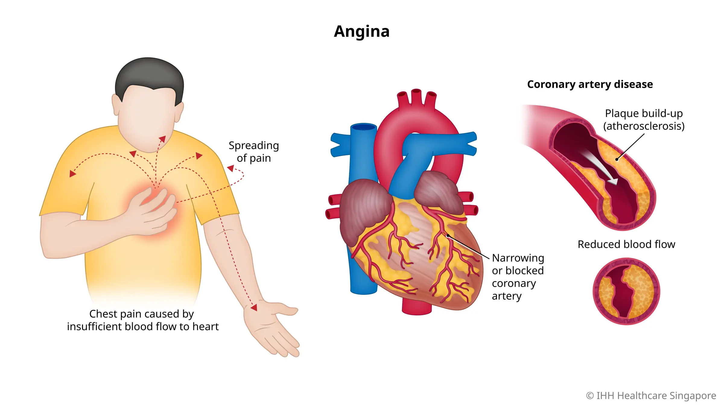 Chest Pain (Angina Pectoris) - Causes, Symptoms & Signs | Gleneagles - Angina Pectoris Hartaanval Waarschuwingen Symptomen Hartaanval