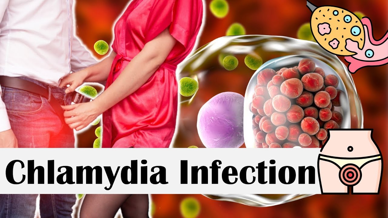 Chlamydia Infection - Causes, Risk Factors, Transmission, Signs - Wat Te Doen Bij Chlamydia