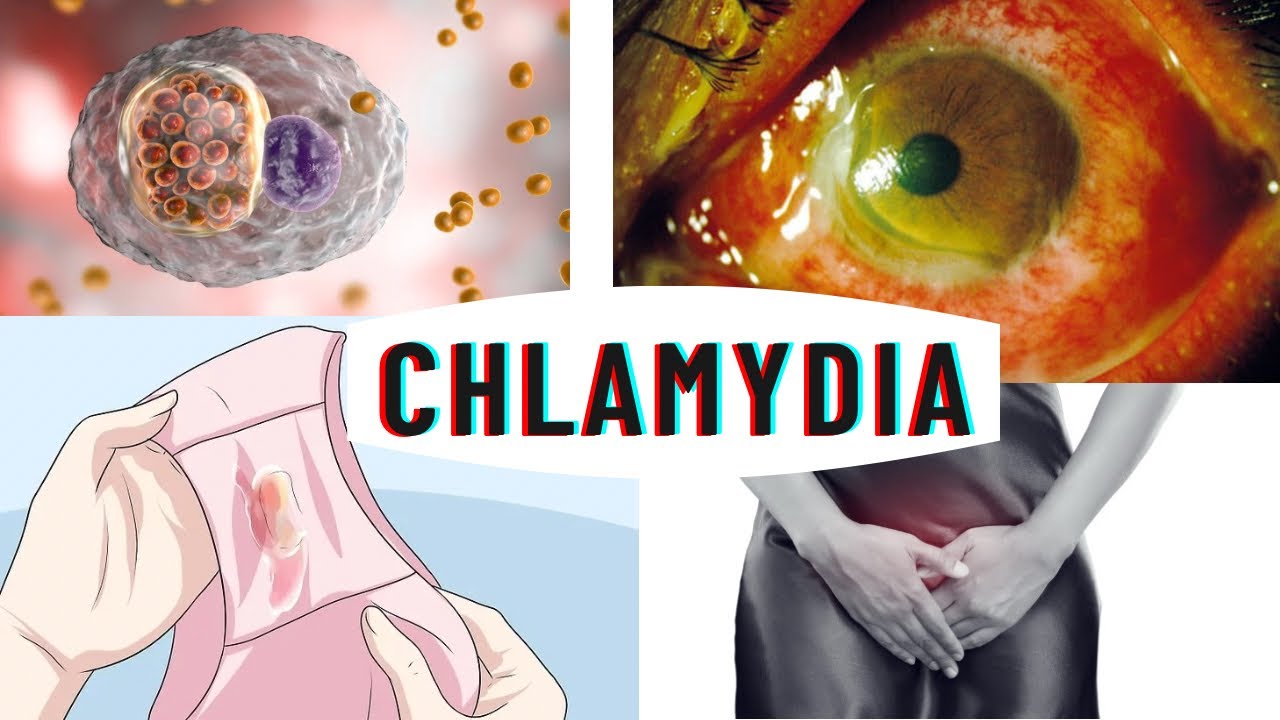 Chlamydia infection - causes, symptoms, complications & diagnosis - YouTube - Kun Je Chlamydia Krijgen Met Condoom
