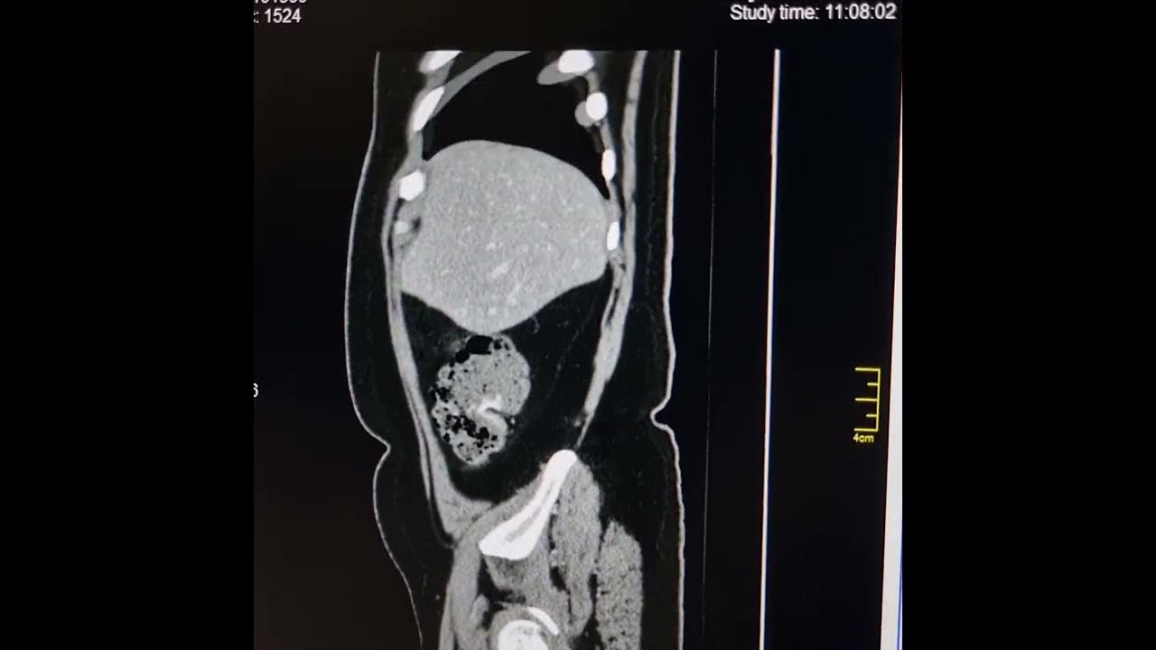 Cholecystolithiasis with acute cholecystitis. - YouTube - Cholecystolithiasis Zonder Tekenen Van Cholecystitis