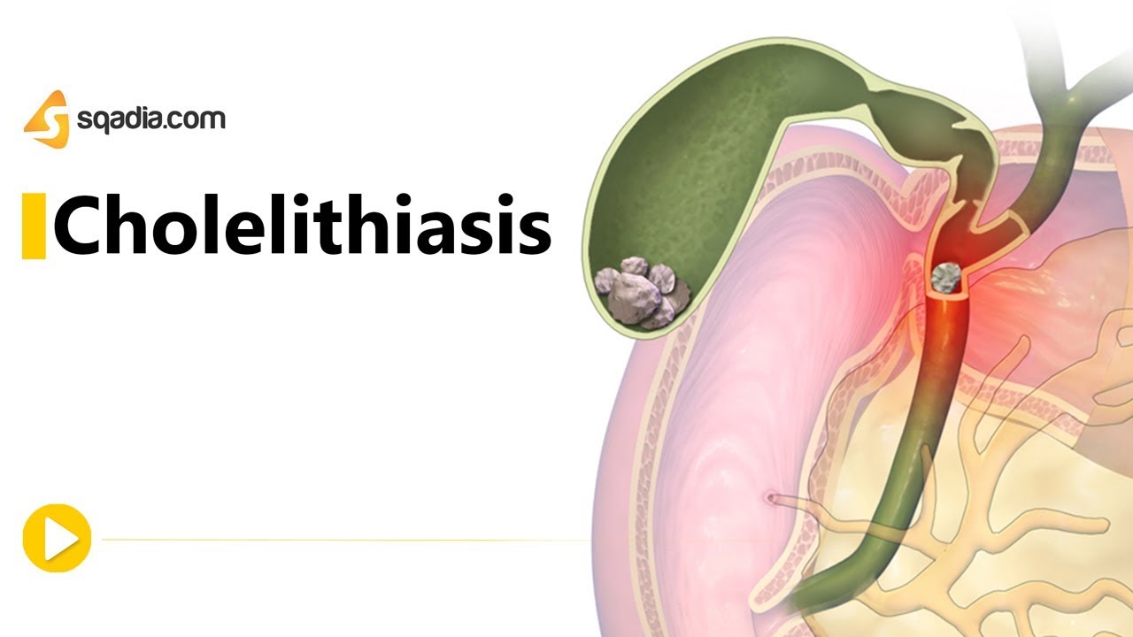 Cholelithiasis -II | Gastroenterology Medicine Animation | Medical V - Cholecystolithiasis Zonder Tekenen Van Cholecystitis