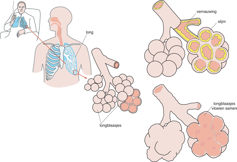 Chronische obstructieve longziekte (COPD) | Apotheek.nl - Wat Is Het Verschil Tussen Longemfyseem En Copd