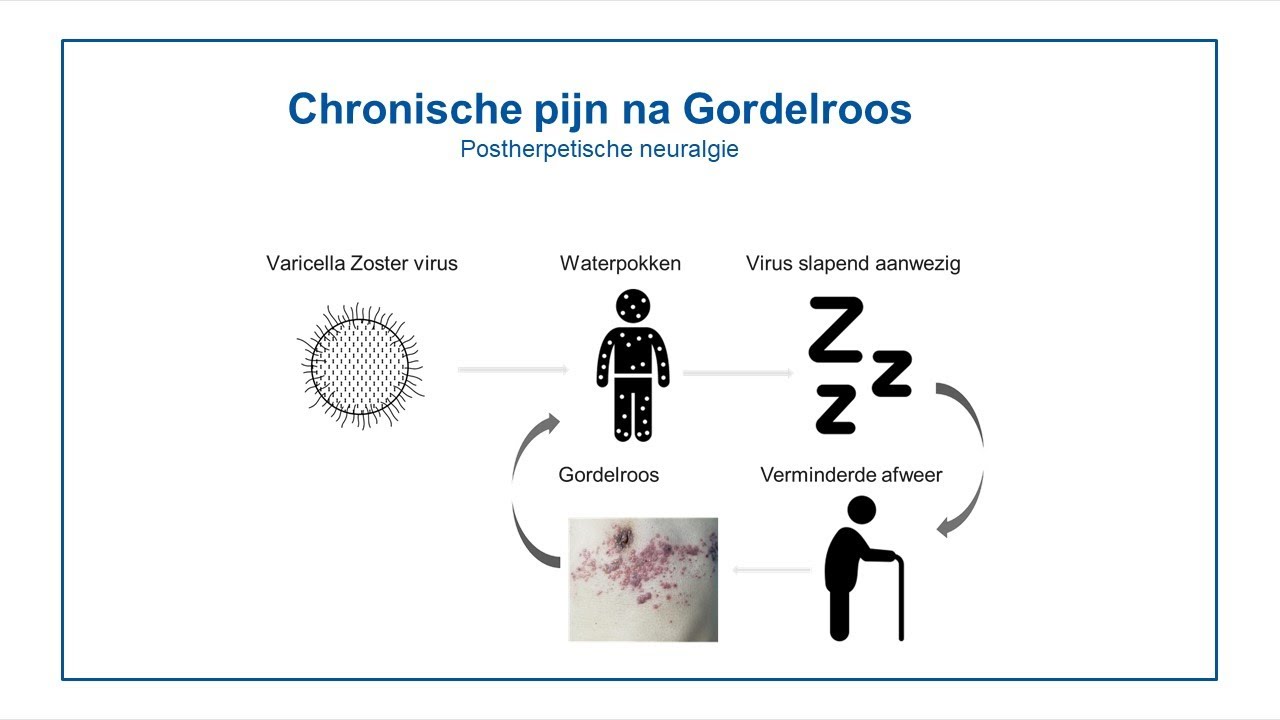 Chronische pijn na Gordelroos - YouTube - Oorpijn En Pijn Bij Slikken
