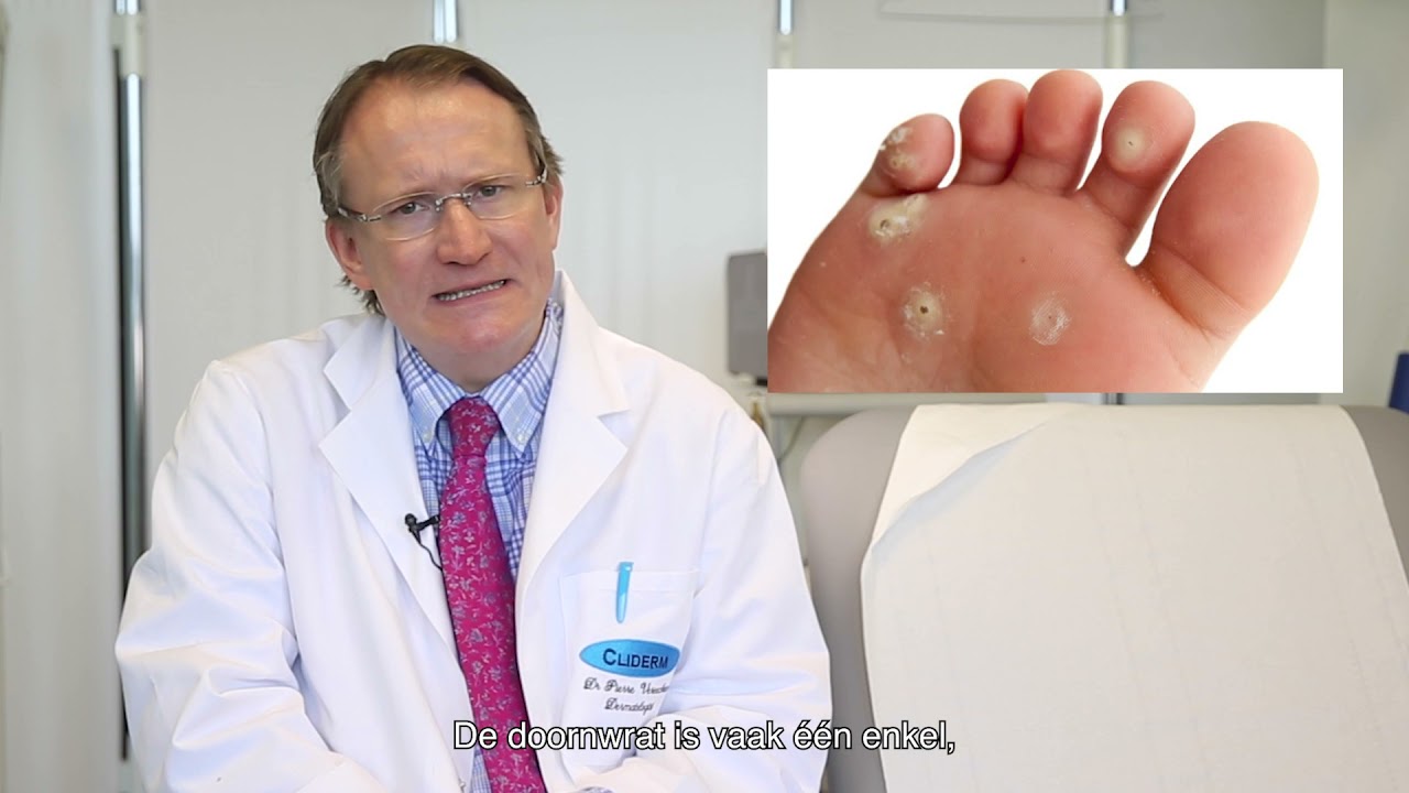 Cliderm: Wratten - Hoe ziet een wrat eruit? - YouTube - Hoe Ontstaat Een Bloedprop In De Hersenen