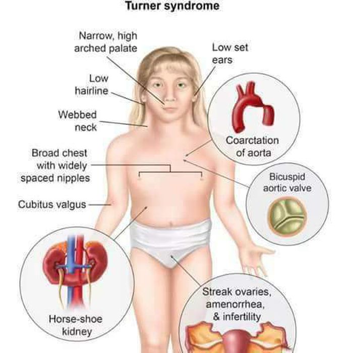 Clinical Signs of Turner Syndrome - MEDizzy - Syndroom Van Turner Uiterlijke Kenmerken