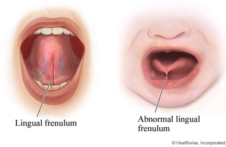 Colic, Disorganised Suckling, & Tongue-Tie: Signs & Solutions | My Baba - Wanneer Is Tongriem Te Kort