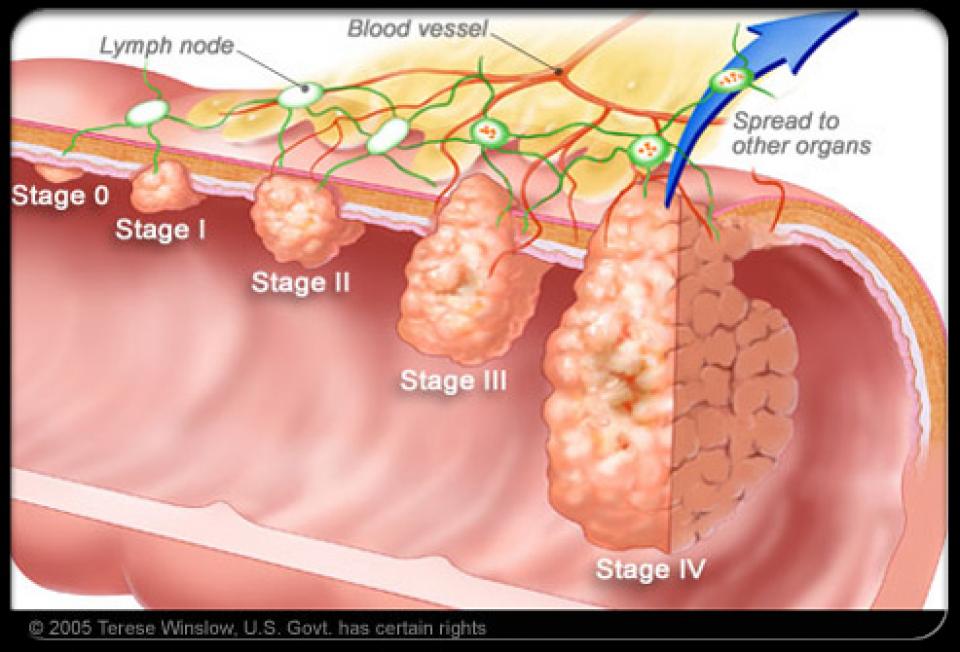 Colon and Rectal Cancer - Bayside Colorectal Group - Hoe Ontstaan Poliepen In De Darmen