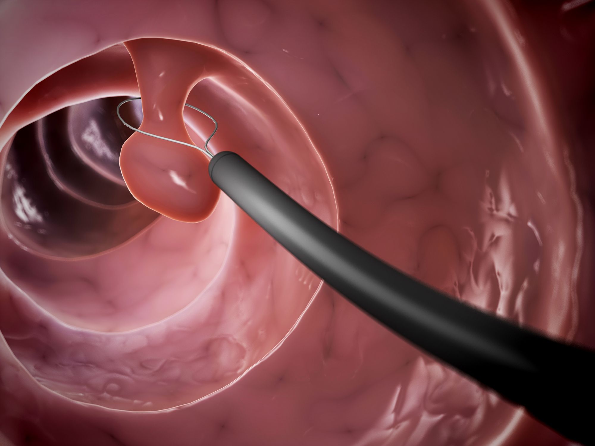 Colon Polyp: Symptoms, Causes, Diagnosis, Treatment - Hoe Ontstaan Poliepen In Je Darmen