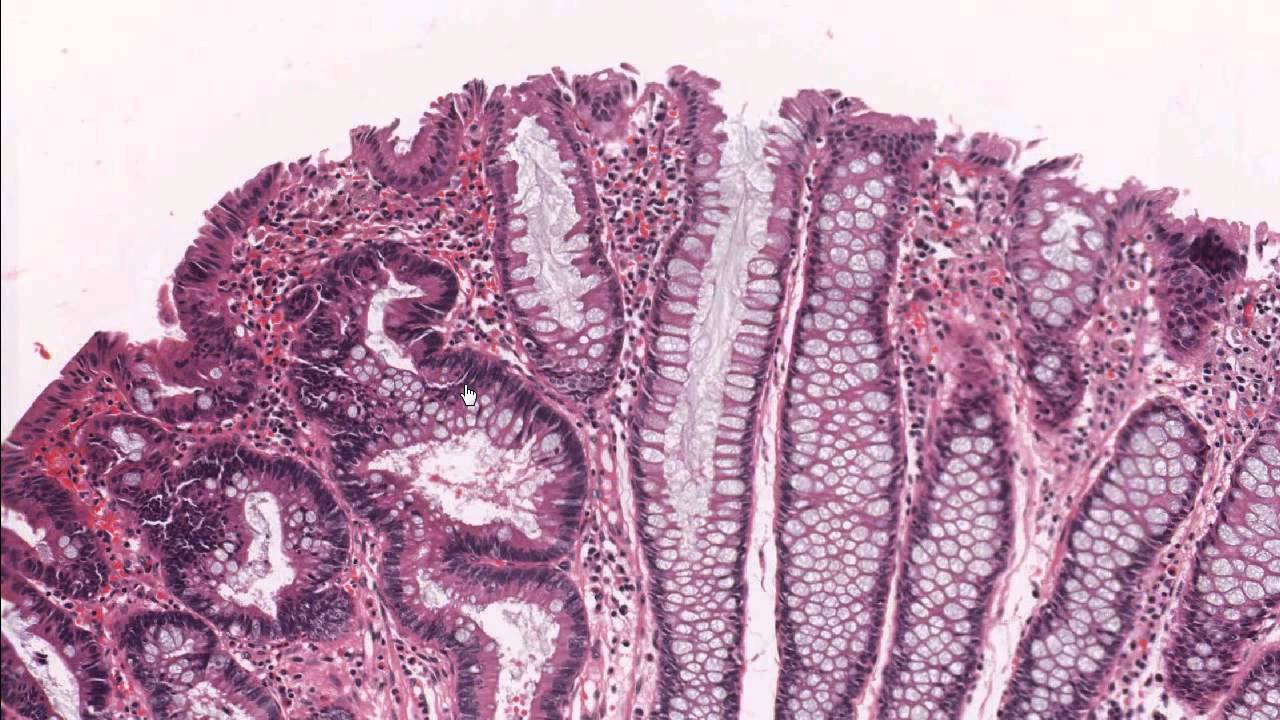 Colon tubular adenoma demonstrating low grade dysplasia / Microscopic - Tubulair Adenoom Met Laaggradig Dysplasie