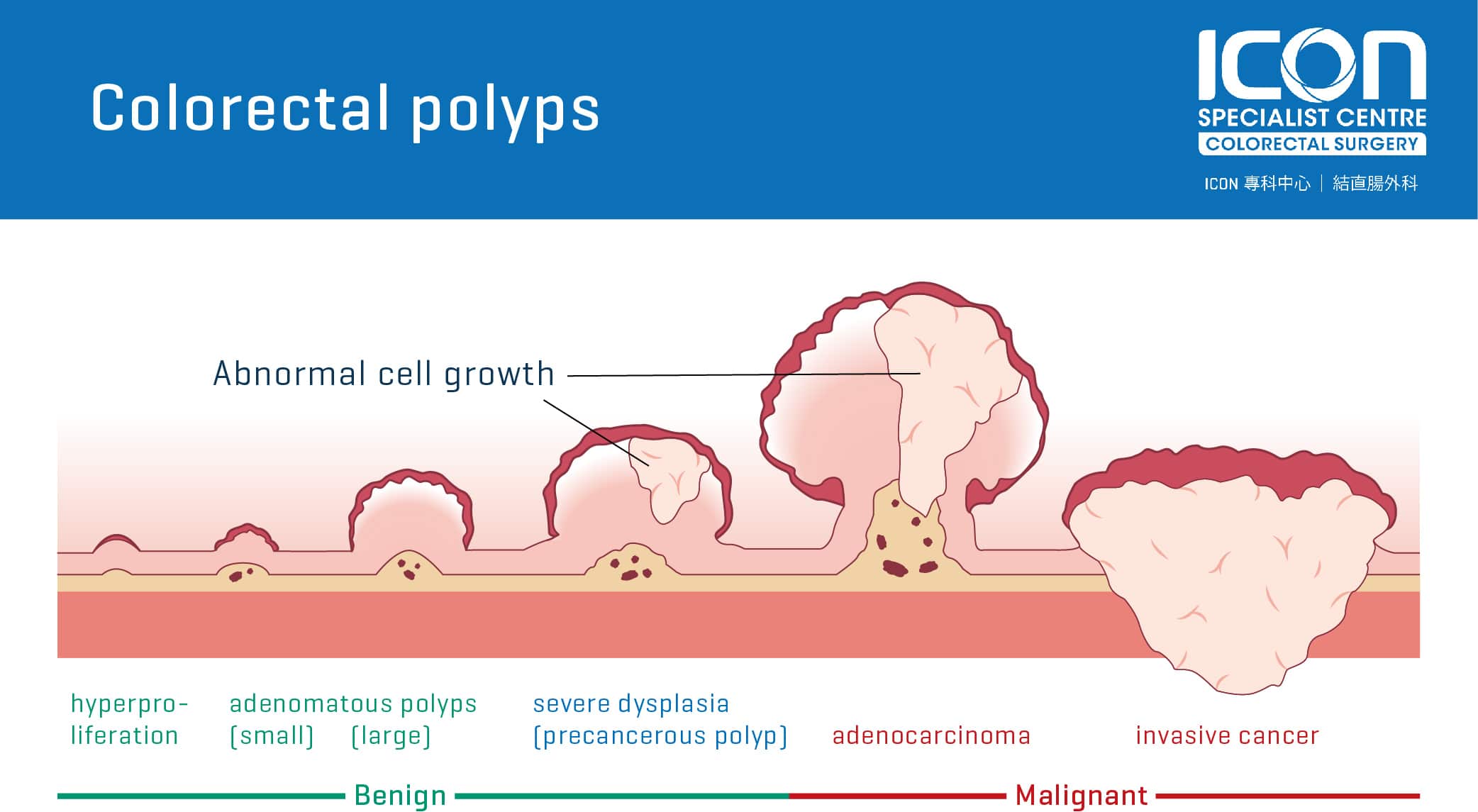 Colorectal polyps — Icon Specialist Centre - Geen Maligniteit Of Cis In Deze Biopsie