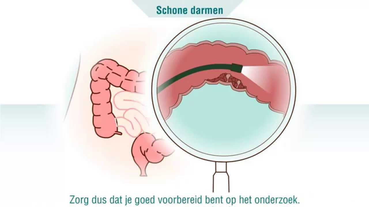 Coloscopie - Wat is het? - YouTube - Waarom Geen Alcohol Voor Coloscopie