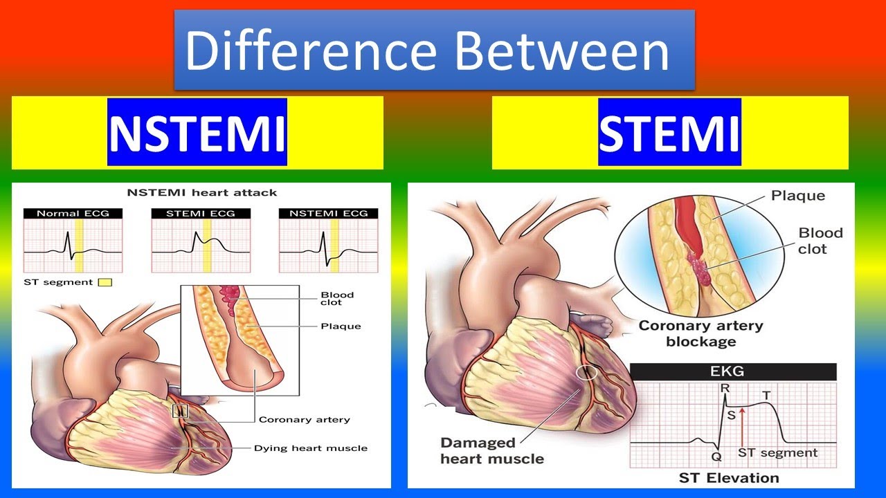 Verschil Stemi En Non Stemi