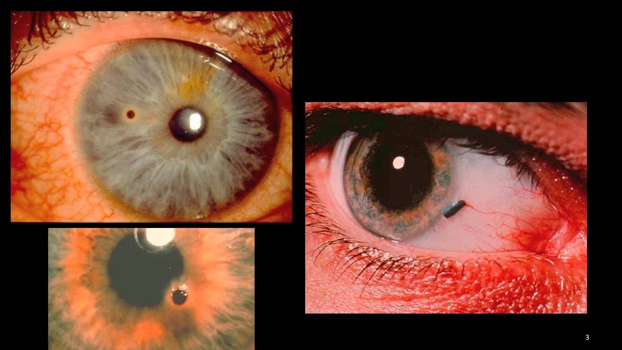 Corneal Foreign Body - YouTube - Waardoor Wordt Stomp Oogletsel Veroorzaakt
