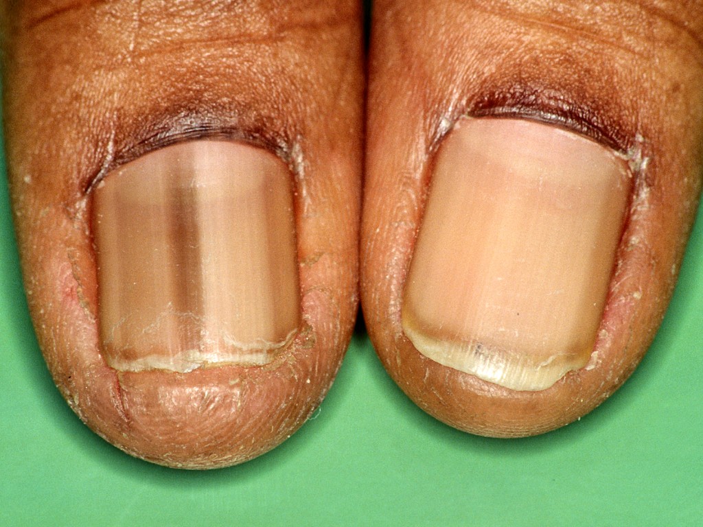 Cosmo nail project on emaze - Bruine Streep Melanoom Nagel Herkennen