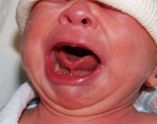 Could Tongue Tie Be The Cause Of Your Baby's Unhappiness? Read Jessica - Wanneer Is Tongriem Te Kort