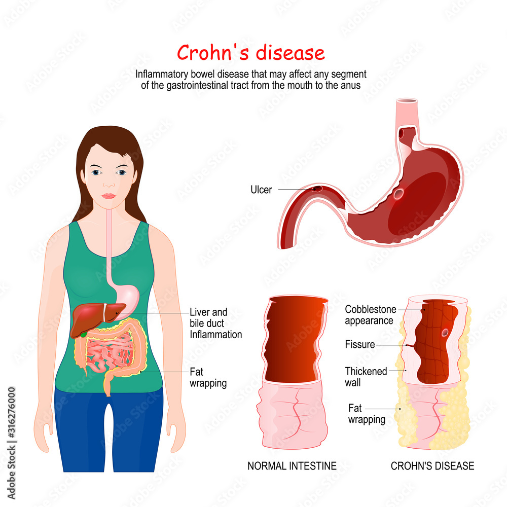 Crohn's disease. Crohn's syndrome. regional enteritis Signs and - Ziekte Van Crohn Symptomen Test