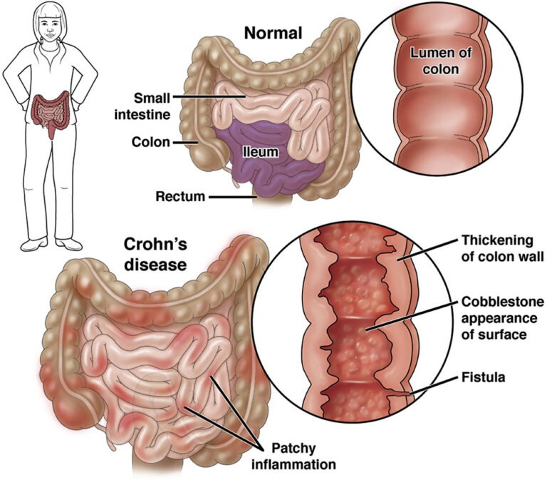 Crohn's Disease - GENEGUT - Verschil Colitis Ulcerosa En Crohn