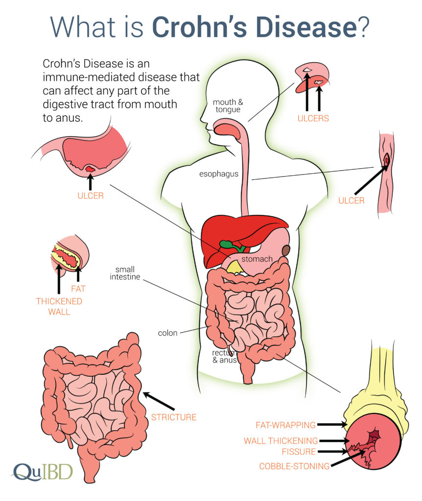 Crohn's Disease Symptoms Prevalence Impact Causes - Ziekte Van Crohn Symptomen Test