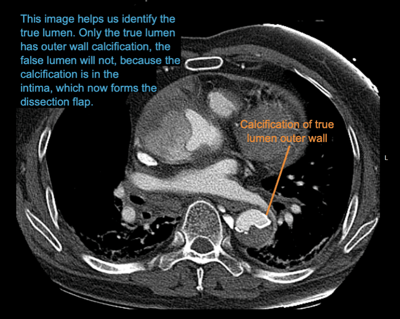CT Case 006 • LITFL • CT scan interpretation - Ct Scan Vergrote Lymfeklier Buik