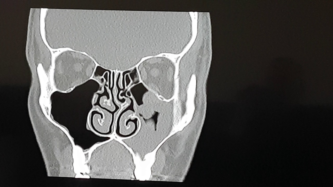 CT Scan Sinusitis - YouTube - Hoe Ziet Een Mri Scanner Eruit