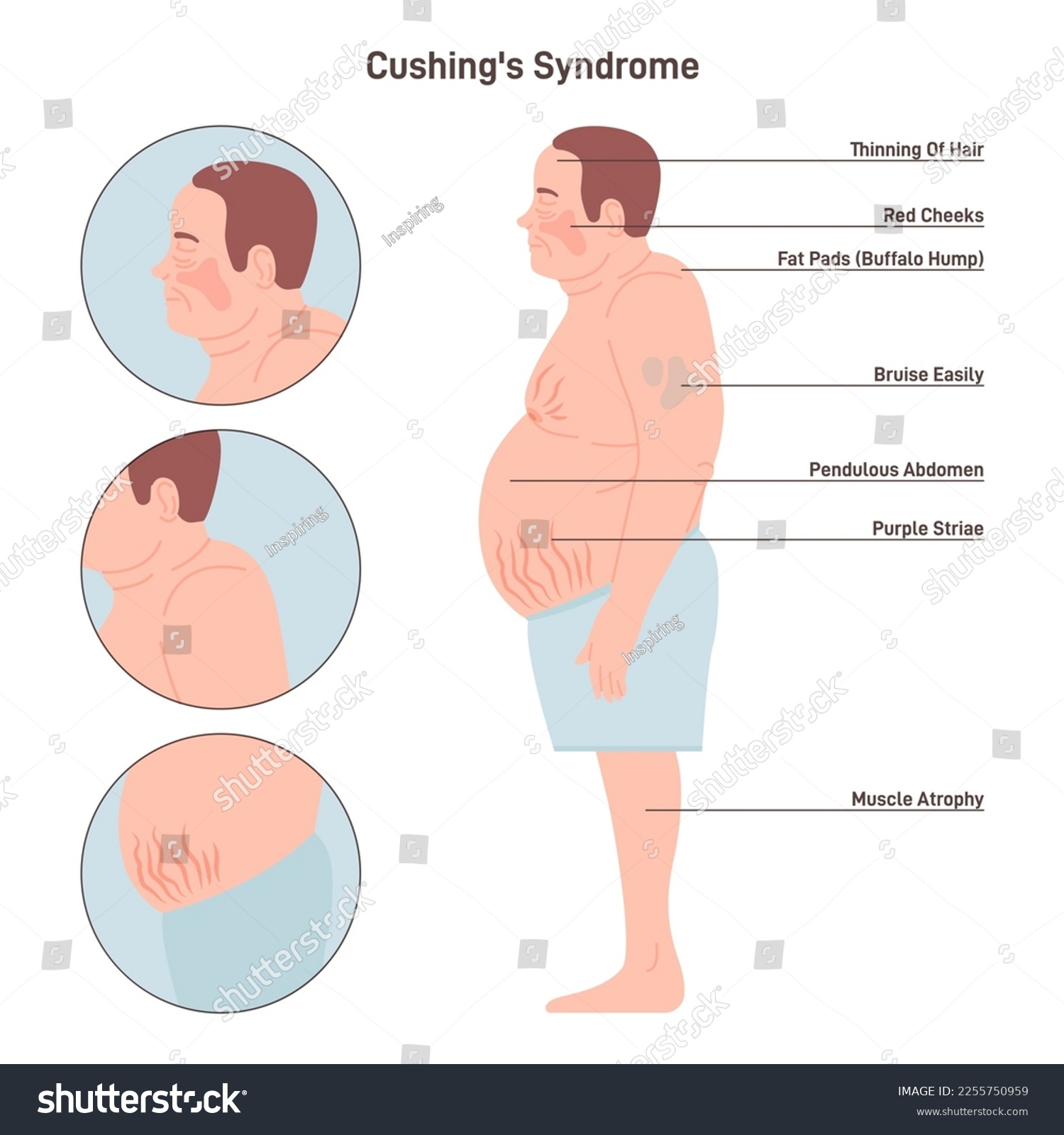 Cushing Syndrome: What Is It, Causes, Treatment, And More, 58% OFF - Ziekte Van Cushing En Werken