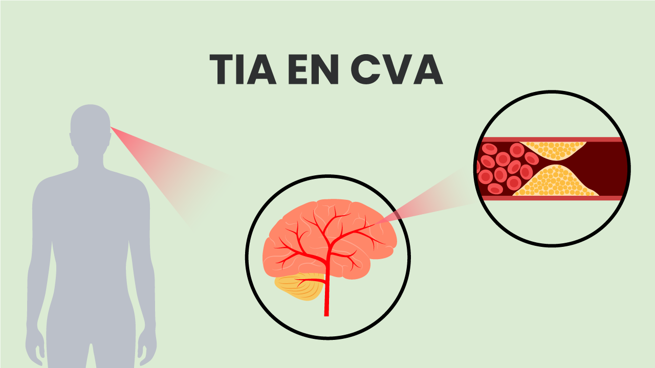 Cva Vs Tia Difference And Comparison - vrogue.co - Verschil Tussen Tia En Beroerte
