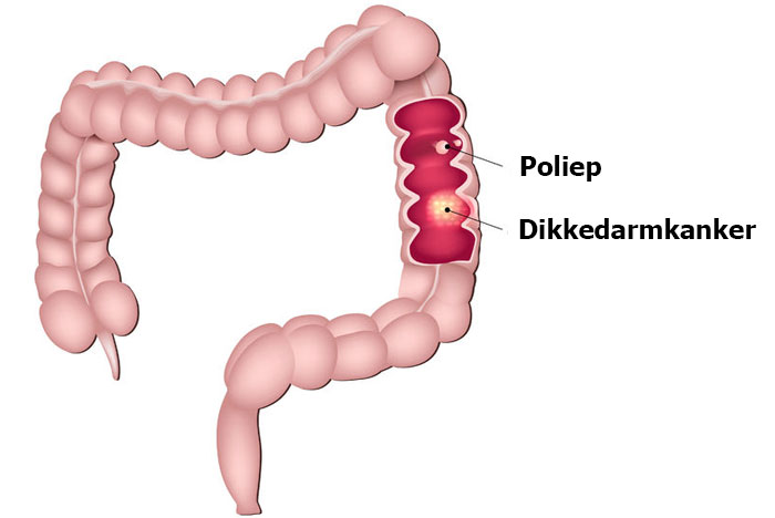 Darmkanker on emaze - Wat Gebeurt Er In De Dikke Darm
